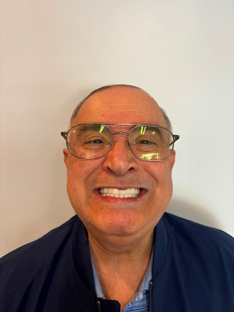 Before and after, Al A., zygomatic implants