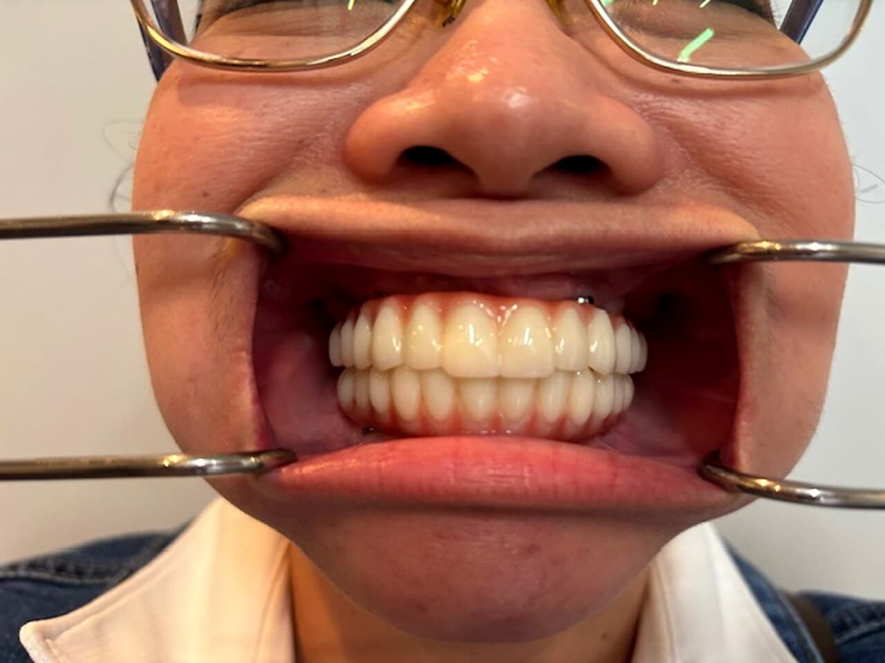 Before and after, Annalyn F., single tooth
