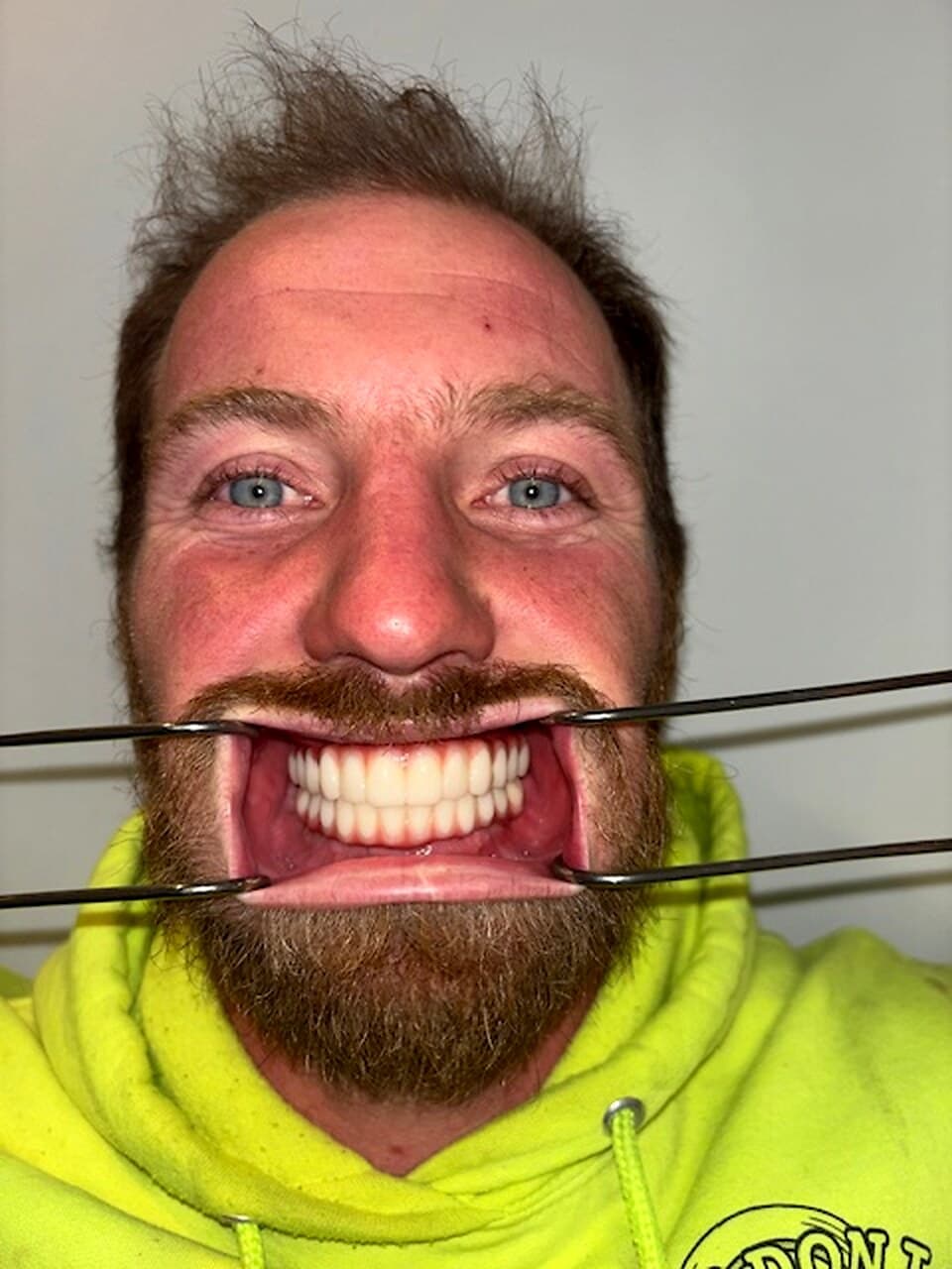 Before and after, David S., All-on-4