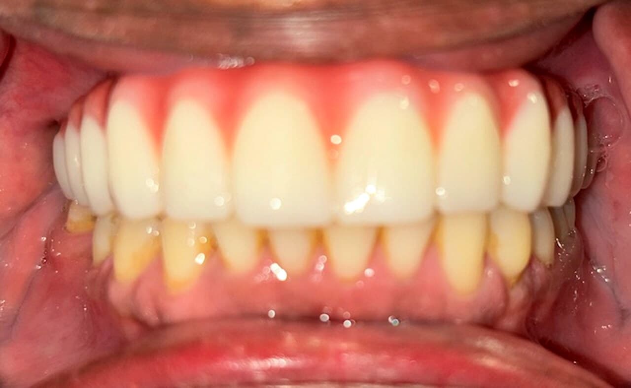 Before and after, James J., full mouth restoration