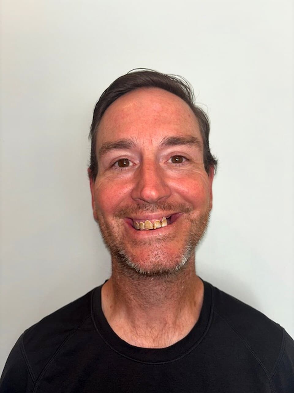 Before and after, Mark P., All-on-4 both arches